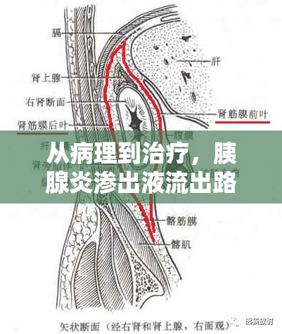 從病理到治療，胰腺炎滲出液流出路線的深度解析與全程探索