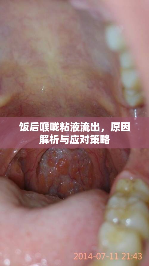 飯后喉嚨粘液流出，原因解析與應(yīng)對策略