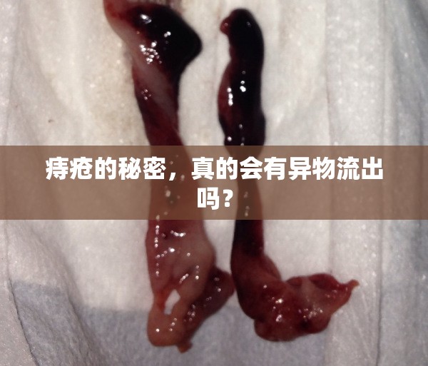 痔瘡的秘密，真的會有異物流出嗎？