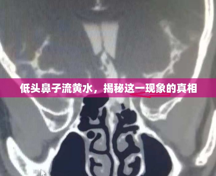 低頭鼻子流黃水，揭秘這一現(xiàn)象的真相