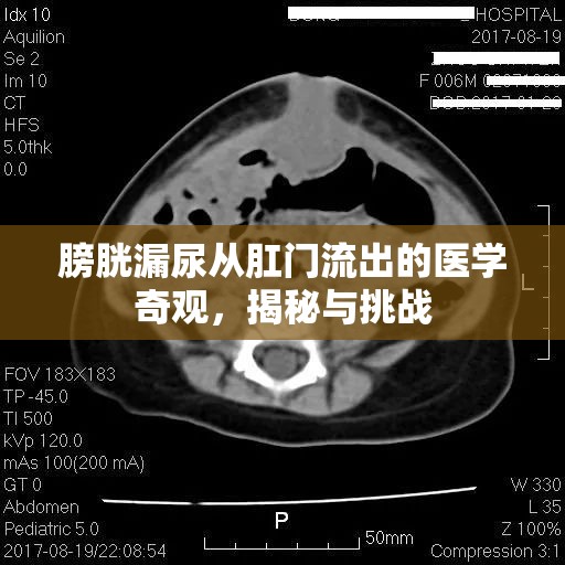 膀胱漏尿從肛門流出的醫(yī)學(xué)奇觀，揭秘與挑戰(zhàn)