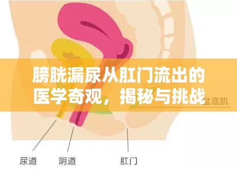 膀胱漏尿從肛門流出的醫(yī)學(xué)奇觀，揭秘與挑戰(zhàn)