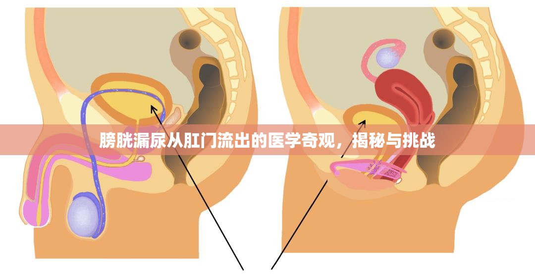 膀胱漏尿從肛門流出的醫(yī)學(xué)奇觀，揭秘與挑戰(zhàn)