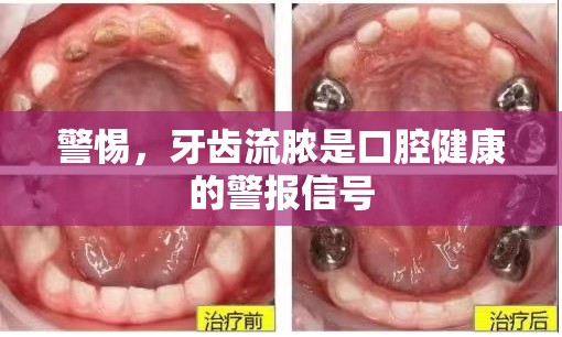 警惕，牙齒流膿是口腔健康的警報信號