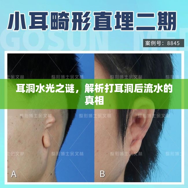 耳洞水光之謎，解析打耳洞后流水的真相