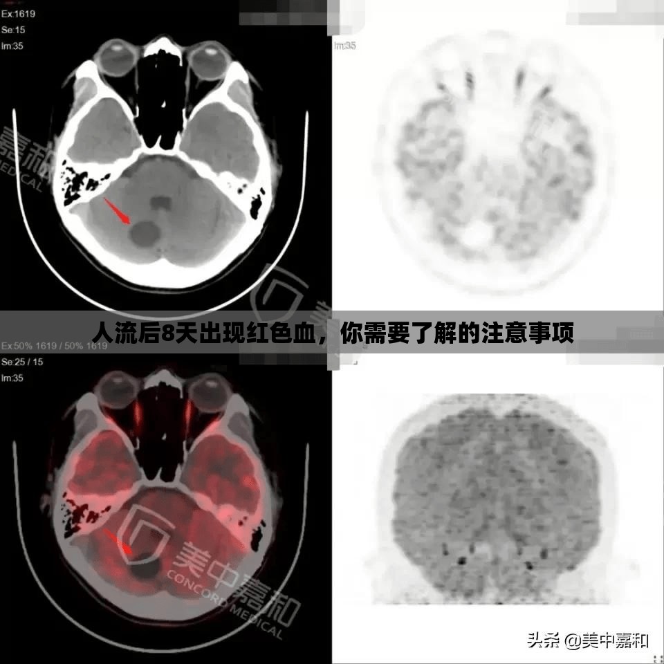 人流后8天出現(xiàn)紅色血，你需要了解的注意事項(xiàng)