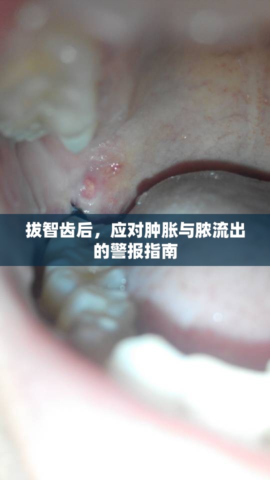拔智齒后，應(yīng)對(duì)腫脹與膿流出的警報(bào)指南