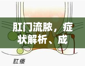肛門流膿，癥狀解析、成因探討及合理用藥指南
