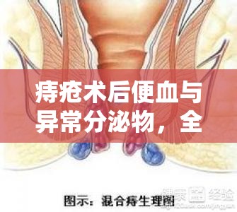 痔瘡術后便血與異常分泌物，全面解析與有效應對策略