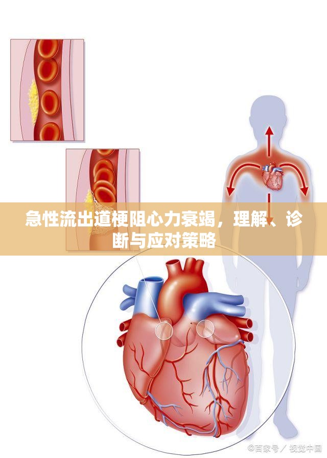 急性流出道梗阻心力衰竭，理解、診斷與應(yīng)對(duì)策略