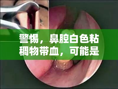 警惕，鼻腔白色粘稠物帶血，可能是健康問題的信號(hào)