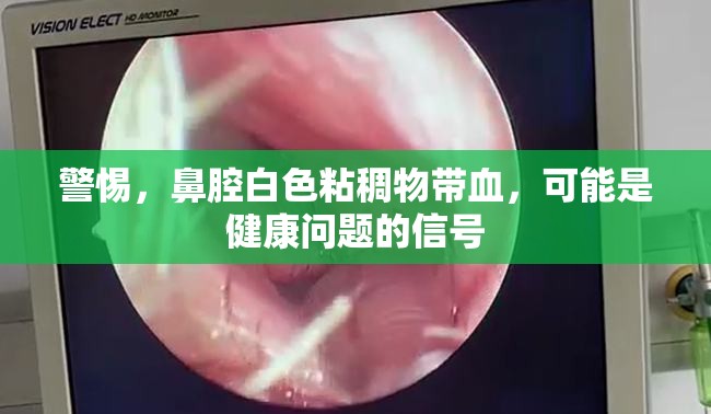 警惕，鼻腔白色粘稠物帶血，可能是健康問題的信號(hào)