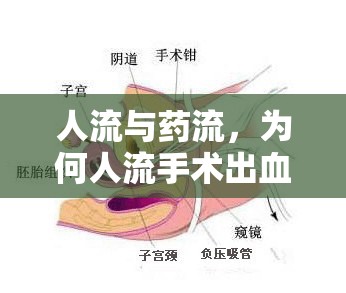 人流與藥流，為何人流手術(shù)出血量相對(duì)較少？