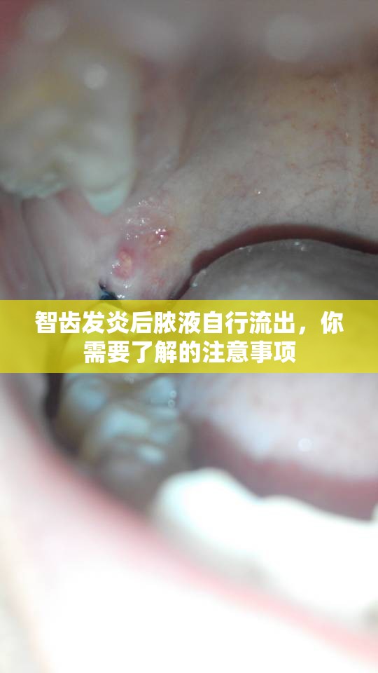 智齒發(fā)炎后膿液自行流出，你需要了解的注意事項
