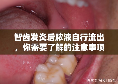 智齒發(fā)炎后膿液自行流出，你需要了解的注意事項