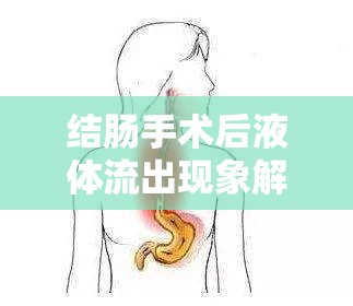 結(jié)腸手術(shù)后液體流出現(xiàn)象解析，術(shù)后護(hù)理與康復(fù)的必備知識(shí)