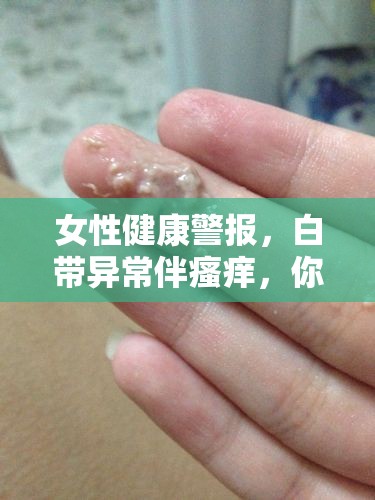 女性健康警報，白帶異常伴瘙癢，你需要了解的真相