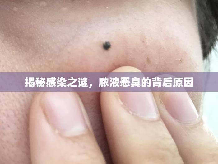 揭秘感染之謎，膿液惡臭的背后原因