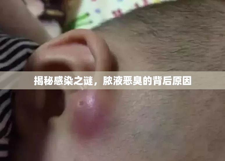揭秘感染之謎，膿液惡臭的背后原因