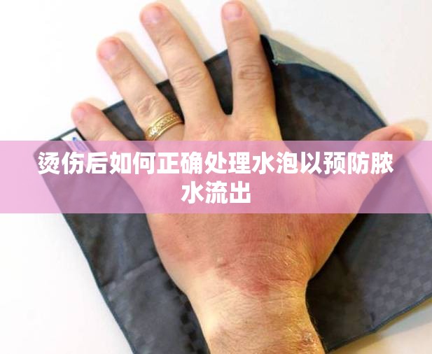 燙傷后如何正確處理水泡以預(yù)防膿水流出