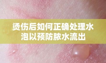 燙傷后如何正確處理水泡以預(yù)防膿水流出