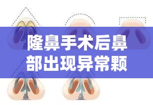 隆鼻手術(shù)后鼻部出現(xiàn)異常顆粒物流出的原因與處理