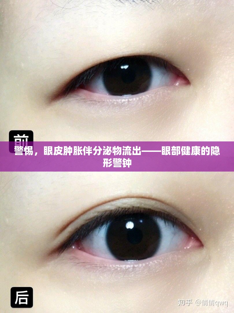 警惕，眼皮腫脹伴分泌物流出——眼部健康的隱形警鐘