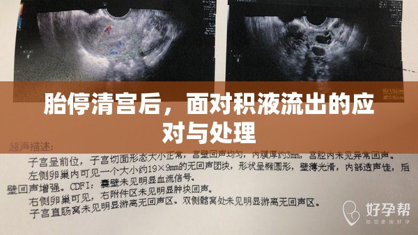 胎停清宮后，面對積液流出的應(yīng)對與處理