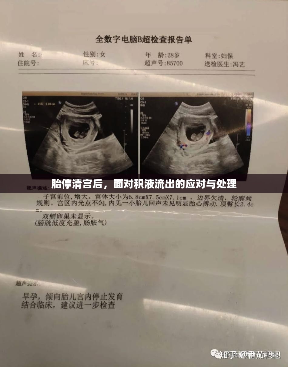胎停清宮后，面對積液流出的應(yīng)對與處理