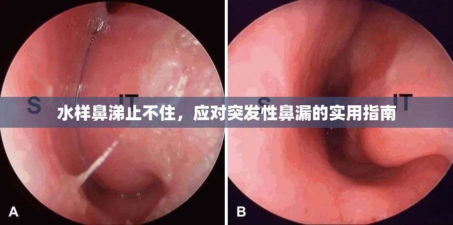 水樣鼻涕止不住，應(yīng)對突發(fā)性鼻漏的實用指南