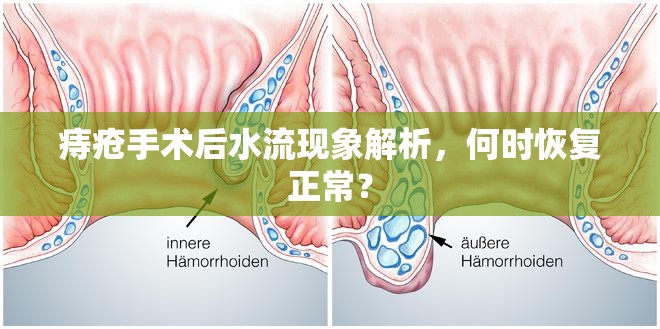 痔瘡手術(shù)后水流現(xiàn)象解析，何時(shí)恢復(fù)正常？