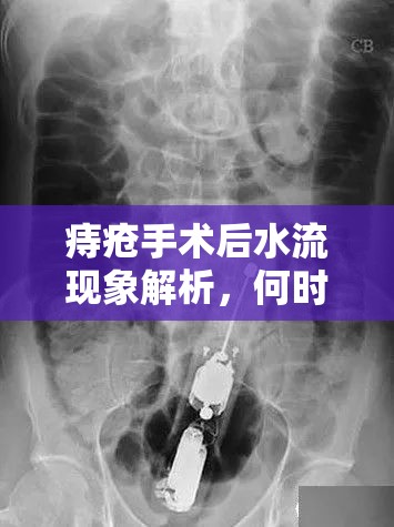 痔瘡手術(shù)后水流現(xiàn)象解析，何時(shí)恢復(fù)正常？