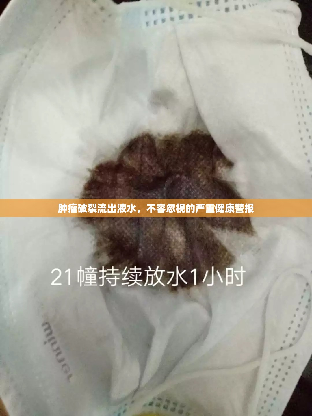 腫瘤破裂流出液水，不容忽視的嚴(yán)重健康警報