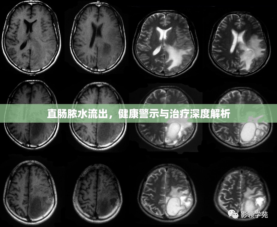 直腸膿水流出，健康警示與治療深度解析