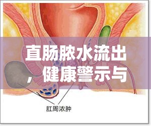 直腸膿水流出，健康警示與治療深度解析