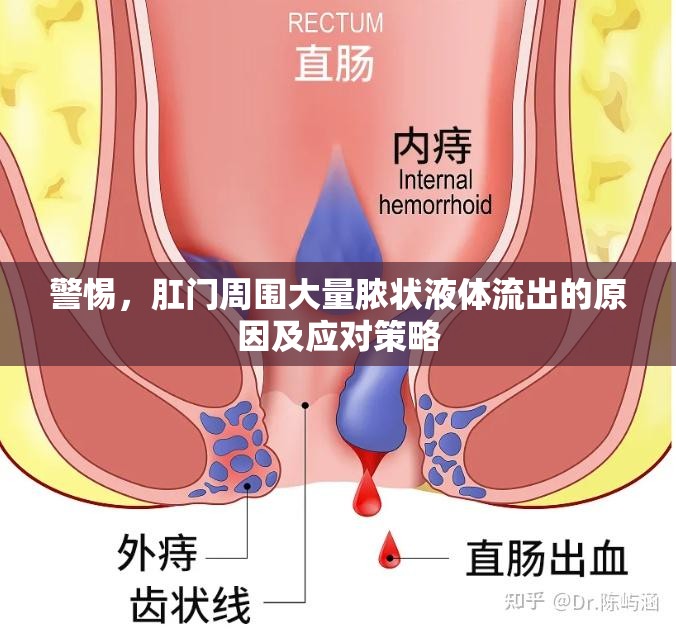 警惕，肛門周圍大量膿狀液體流出的原因及應對策略