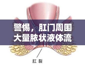 警惕，肛門周圍大量膿狀液體流出的原因及應對策略