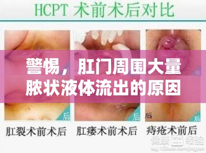 警惕，肛門周圍大量膿狀液體流出的原因及應對策略