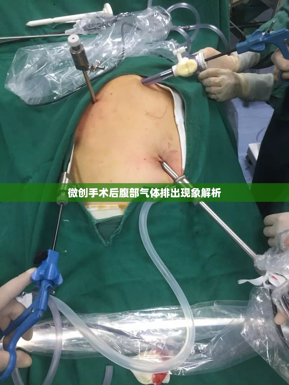 微創(chuàng)手術(shù)后腹部氣體排出現(xiàn)象解析