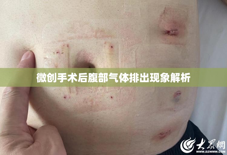 微創(chuàng)手術(shù)后腹部氣體排出現(xiàn)象解析