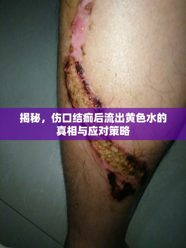 揭秘，傷口結(jié)痂后流出黃色水的真相與應(yīng)對策略