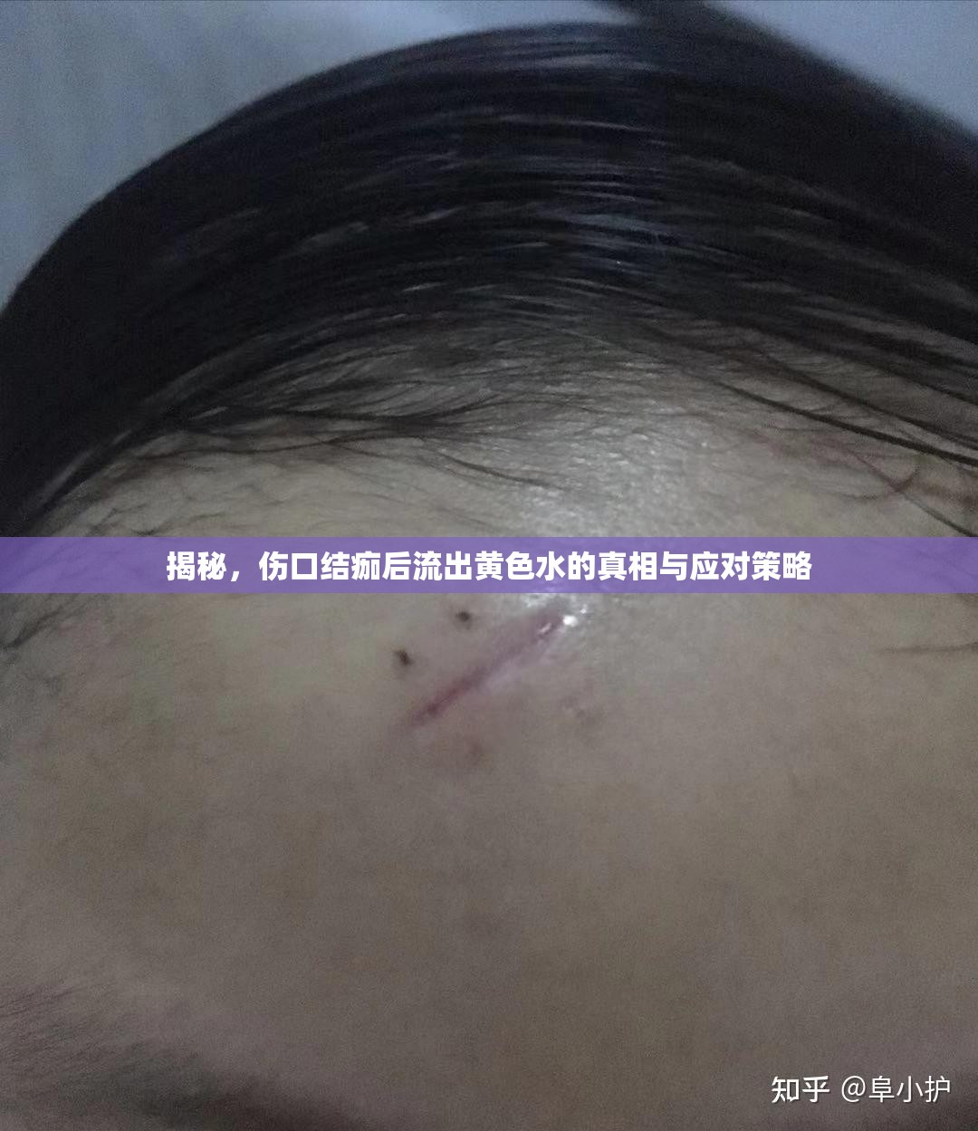揭秘，傷口結(jié)痂后流出黃色水的真相與應(yīng)對策略