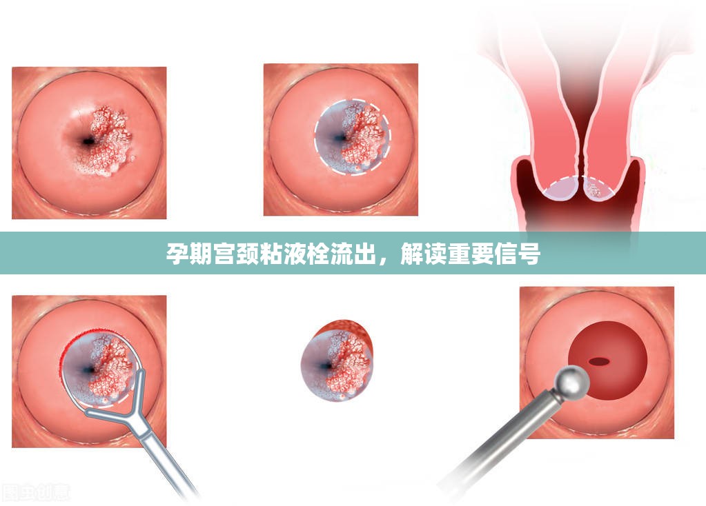孕期宮頸粘液栓流出，解讀重要信號(hào)