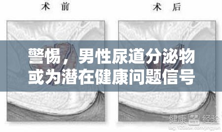 警惕，男性尿道分泌物或為潛在健康問題信號