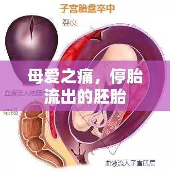母愛(ài)之痛，停胎流出的胚胎
