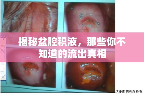揭秘盆腔積液，那些你不知道的流出真相