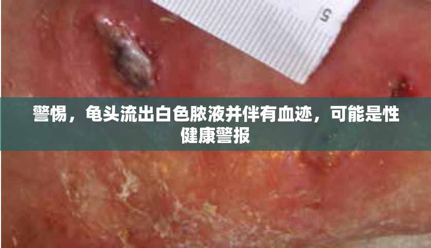 警惕，龜頭流出白色膿液并伴有血跡，可能是性健康警報(bào)
