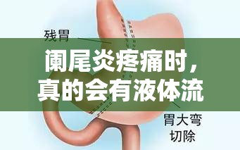 闌尾炎疼痛時(shí)，真的會(huì)有液體流出嗎？——一場身體小秘密的科普之旅