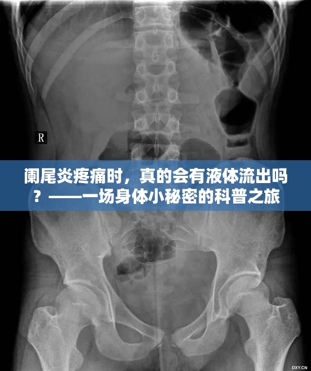 闌尾炎疼痛時(shí)，真的會(huì)有液體流出嗎？——一場身體小秘密的科普之旅