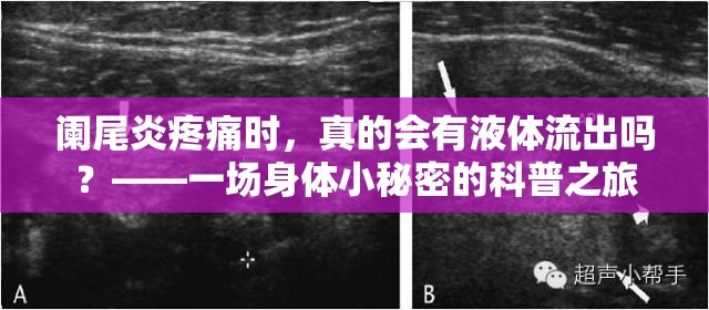 闌尾炎疼痛時(shí)，真的會(huì)有液體流出嗎？——一場身體小秘密的科普之旅